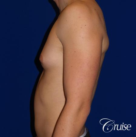 Best moderate gynecomastia on male adult - Before and After Image 2