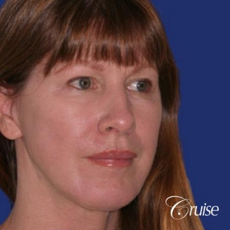 52 year old with chin augmentation and facelift - After Image 2