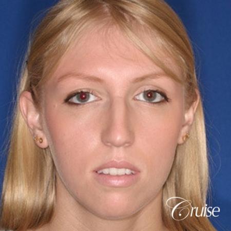 young female with large anatomic chin implant - Before Image 1