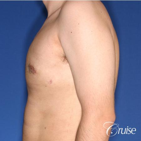 moderate gynecomastia puffy nipple - After Image 2