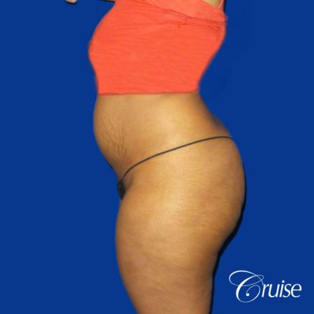 Best Tummy Tuck surgeons Newport Beach - Before Image 3