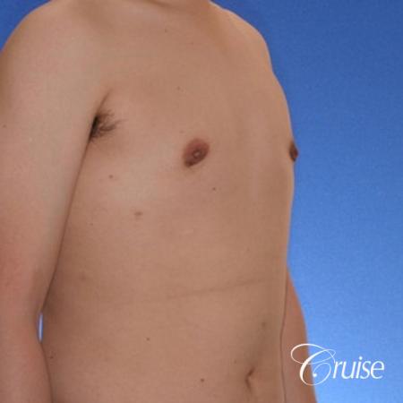 young male with mild gynecomastia surgery for puffy nipple - After Image 4