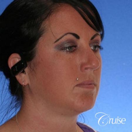 before and after photos of female chin implant - After Image 3