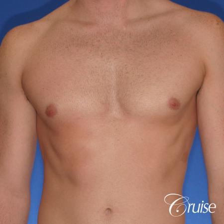 body builder with puffy nipples gets gyne surgery - After Image 1
