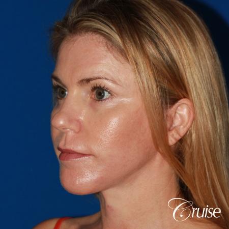 best small anatomic implant photos - After Image 3