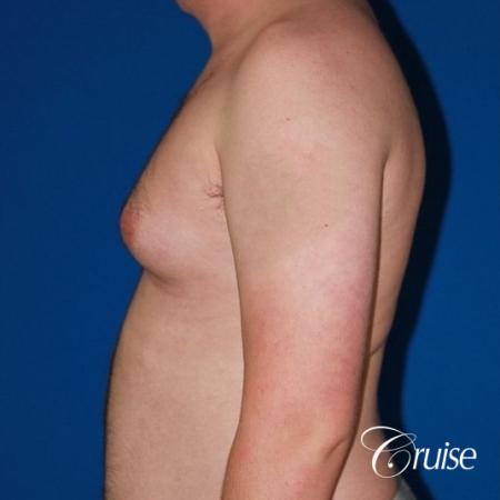 asymmetric gynecomastia moderate - Before Image 3