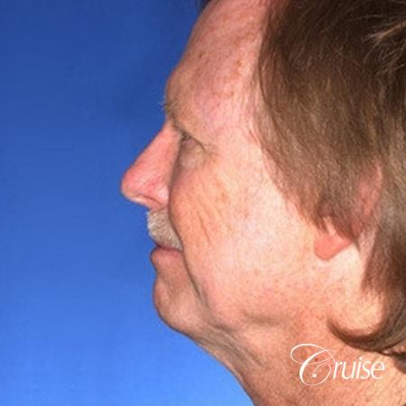 62 yr old with medium square chin augmentation - Before Image 2