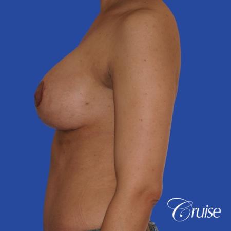 best scars for breast lift anchor saline in Newport Beach, Orange County - After Image 2