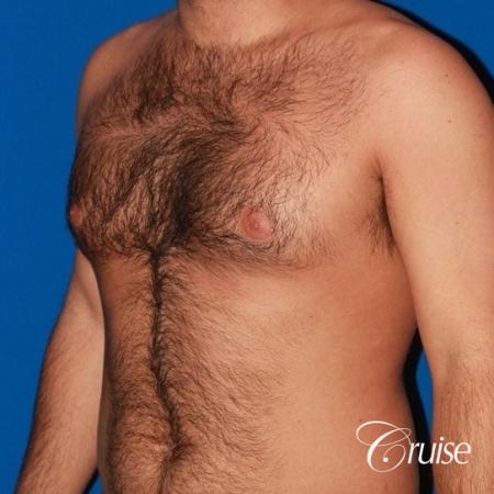 moderate gynecomastia on adult - Before and After 3