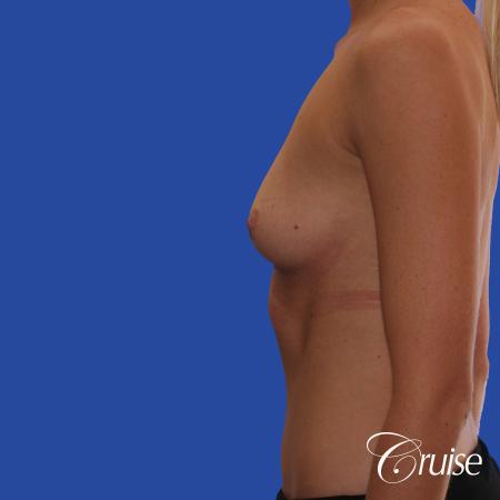 Breast Augmentation - Before Image 2