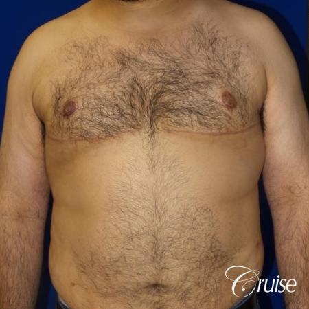 Gynecomastia -Free Nipple Graft - After Image 1