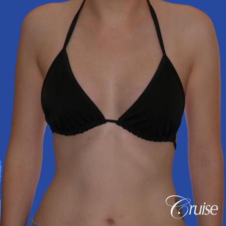 Breast Augmentation - After Image 3