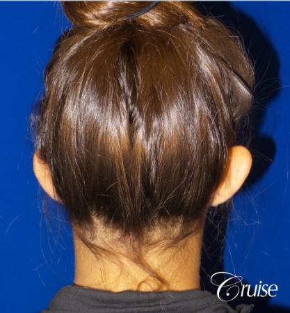 Otoplasty - Before and After Image 3