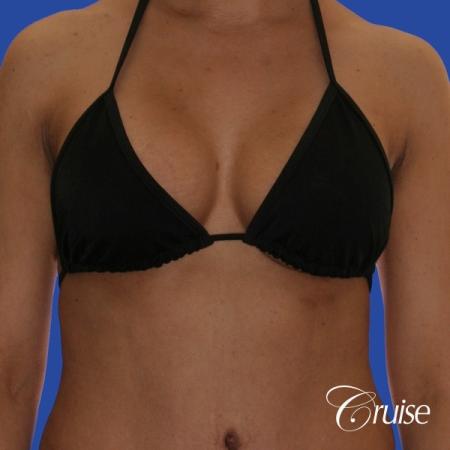 best scars for breast lift anchor saline in Newport Beach, Orange County - After Image 4