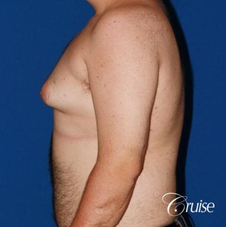 moderate gynecomastia with pointy man boobs - Before Image 2