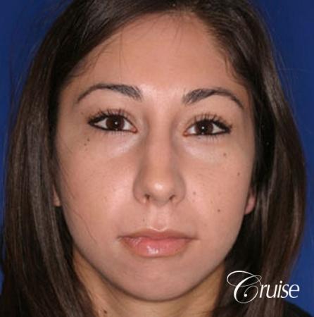 anatomic chin implant with top plastic surgeon in Newport Beach - Before Image 1