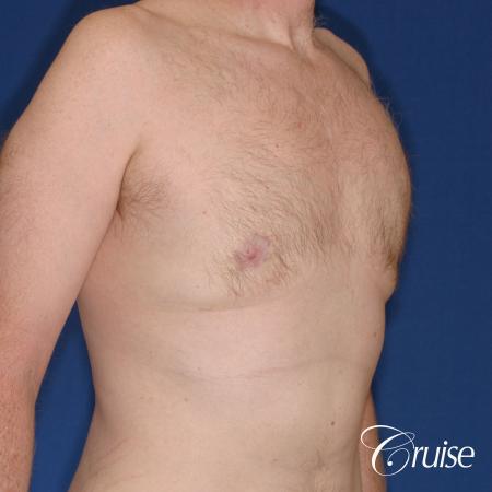 best donut lift with gynecomastia surgery - After Image 4