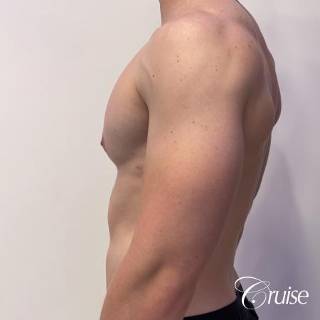 gynecomastia with puffy nipples - After Image 2