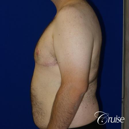 gynecomastia with free nipple graft - 1 After Image 3_2