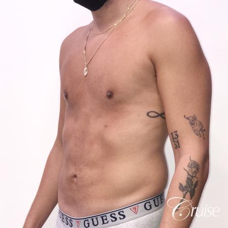 gynecomastia correction orange county - After Image 3