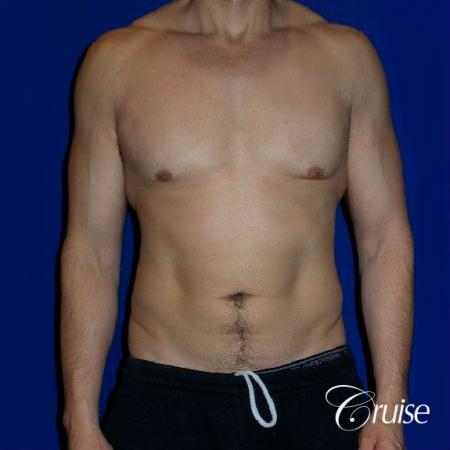 Moderate Gynecomastia -Pedicle - Before Image 1