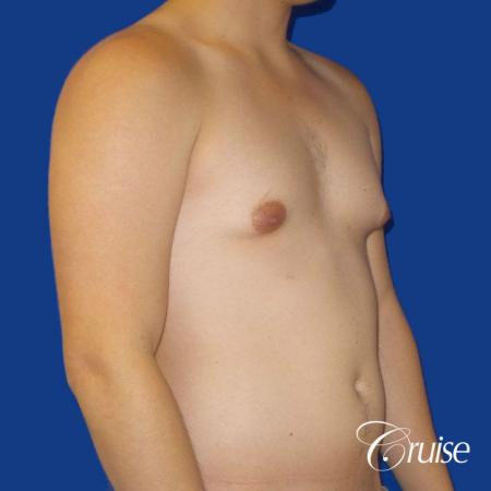 Best Gynecomastia surgeons Southern California - Before and After Image 4