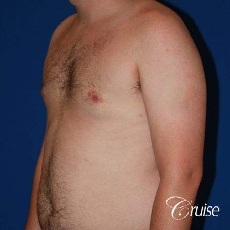 asymmetric gynecomastia moderate - After Image 2
