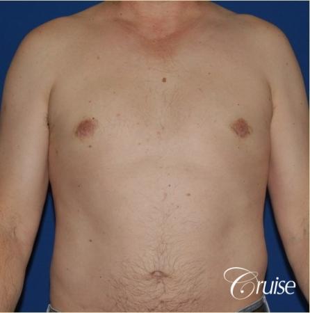 moderate gyne on mature adult 49 - After Image 1