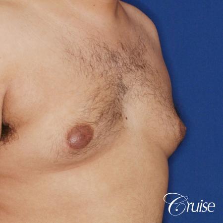 best scar on 32 gynecomastia patient - Before Image 3