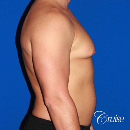 body builder with Gynecomastia puffy nipple - Before and After Image 5