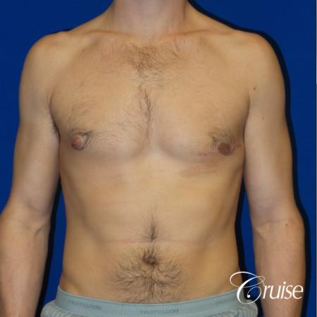 Unilateral gynecomastia - After Image 1
