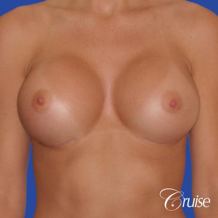 Breast Augmentation - After 1