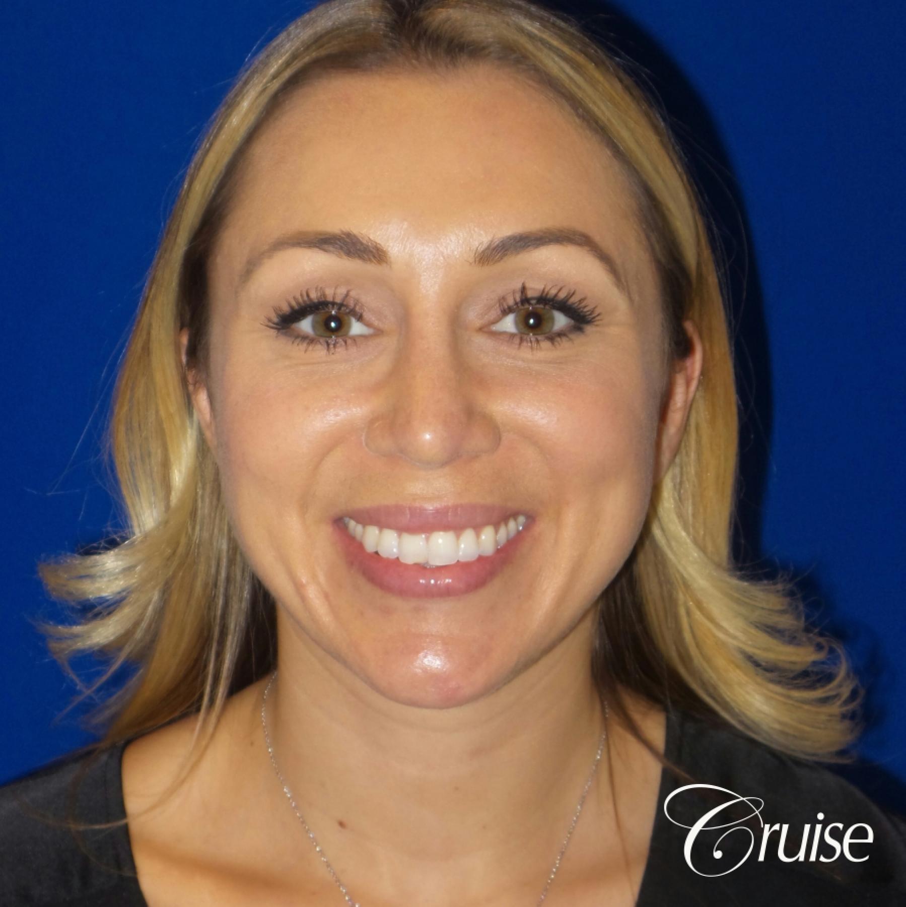 Rhinoplasty: Hump Reduction & Nasal Tip Refinement - After  
