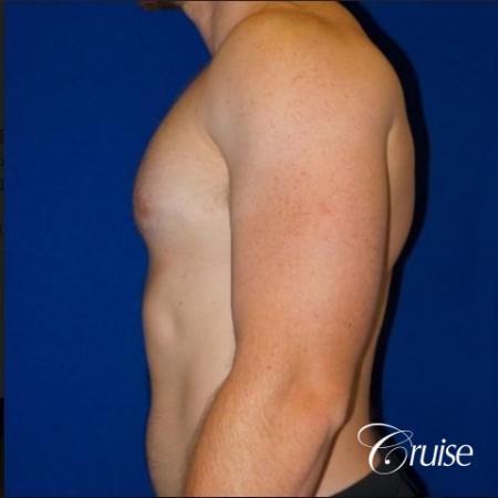 Dr. Cruise gynecomastia surgery photos - After Image 5