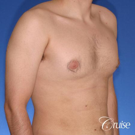 moderate gynecomastia puffy nipple - Before and After Image 4