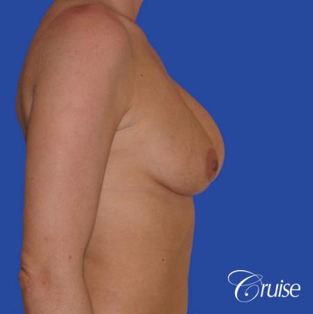 breast revision with silicone implant rupture - Before Image 3