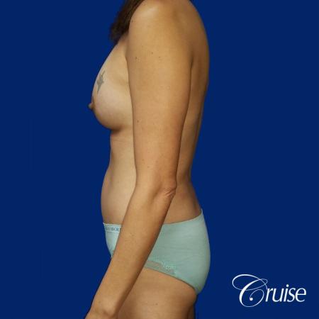 Best Tummy Tuck before and afters Dr. Cruise - After Image 3