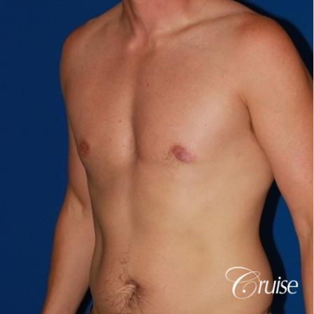 puffy nipple on 35 yr old male - After Image 3