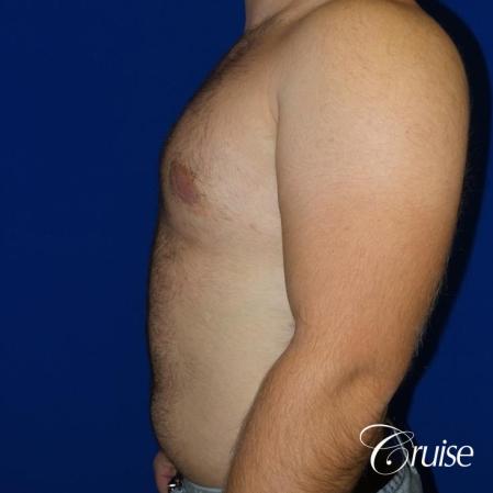 best gynecomastia results - After Image 3