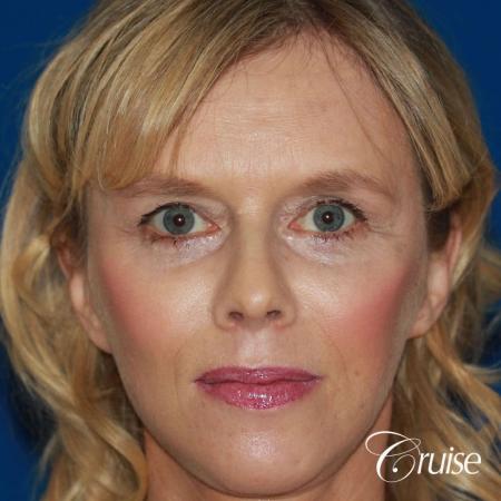 Fat Transfer - Face: Patient 19 - After Image