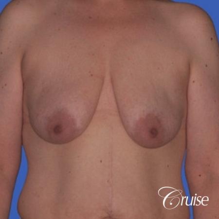 best photos of breast lift anchor on 39 yr old - Before Image 1