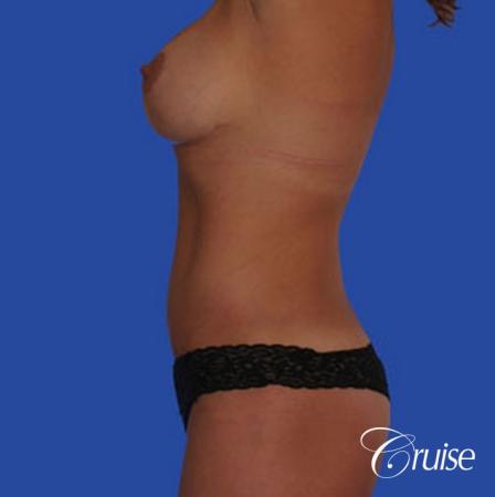 mommy makeover with best breast lift anchor with saline implants - After Image 2