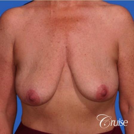 best breast lift anchor with saline augmentation - Before Image 1