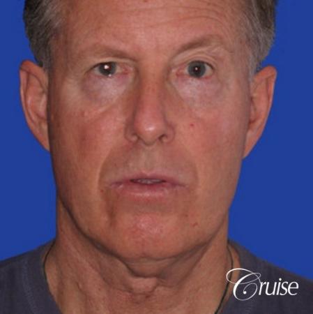 62 year old with chin implant and neck lift - Before Image 1