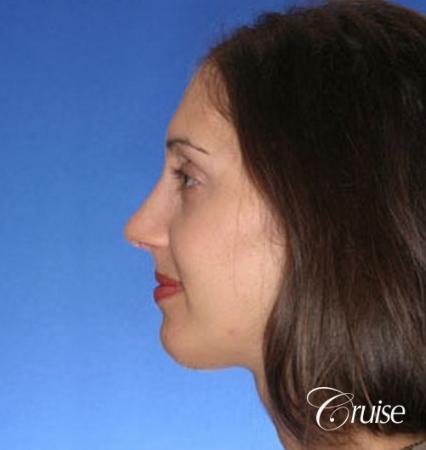 29 yr old with large female chin augmentation - After Image 2