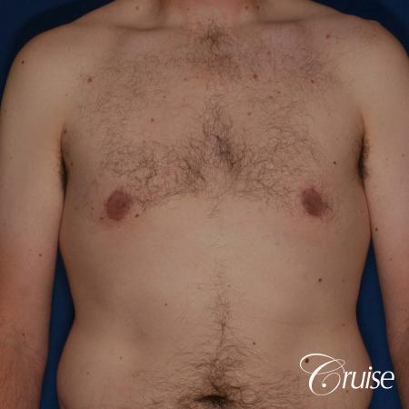 adult male with moderate gynecomastia gets donut lift - After Image 1