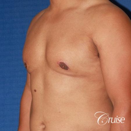 donut lift gynecomastia moderate adult - After Image 2