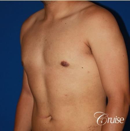 puffy nipple on 26 year old with gynecomastia - After Image 2