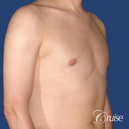 moderate gynecomastia on adult donut lift - After Image 4