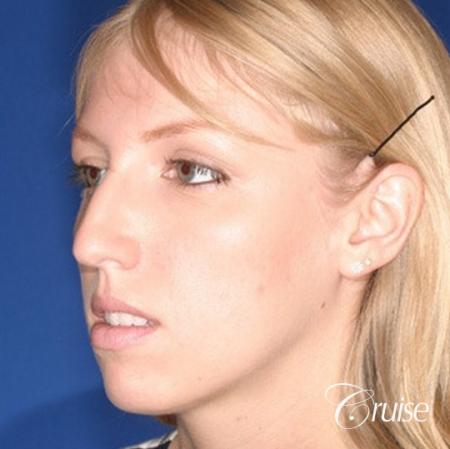 young female with large anatomic chin implant - Before Image 3